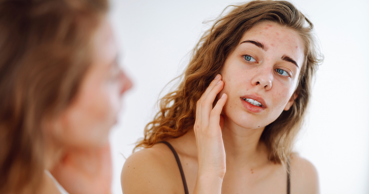 Is Your Acne Caused By Inflammation & Leaky Gut? The Gut-Skin Axis, Part 2
